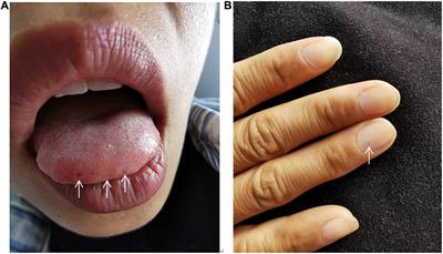 Case report: Pulmonary arterial hypertension in ENG-related hereditary hemorrhagic telangiectasia